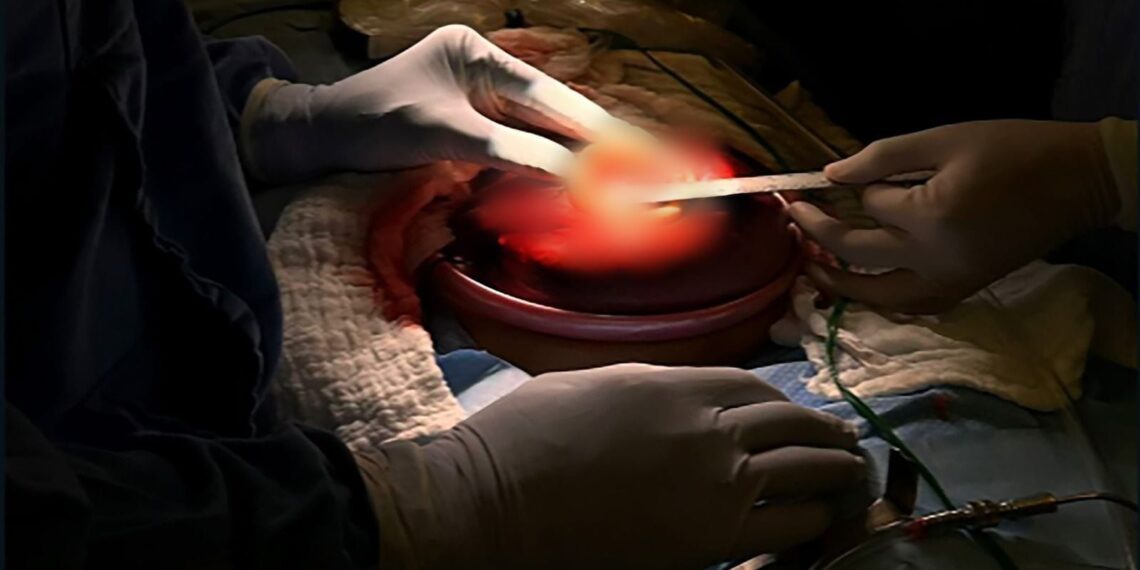 Veracruz hace historia: realizan con éxito la primera cirugía fetal en hospital público